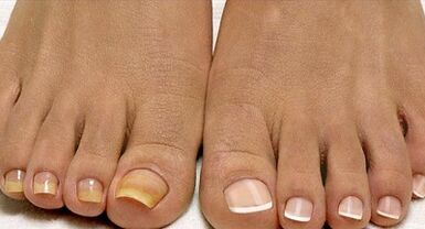 Métodos de tratamento de fungos de frota