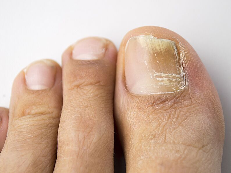 O estágio inicial do fungo