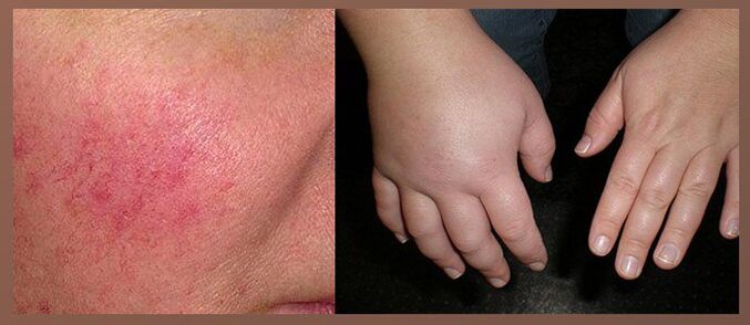 Efeitos colaterais de gotas